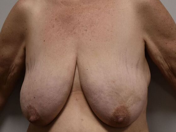 Breast Lift (Mastopexy): Case 216 - Before