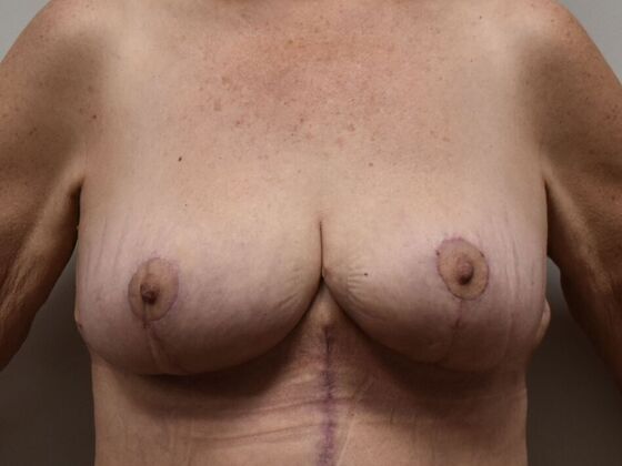 Breast Lift (Mastopexy) Case 216 - After