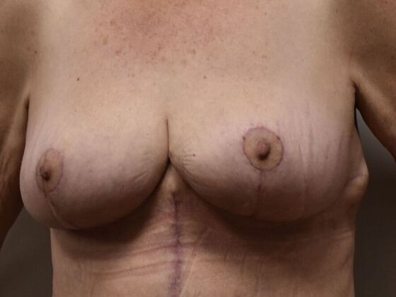 Breast Lift (Mastopexy): Case 216 - After