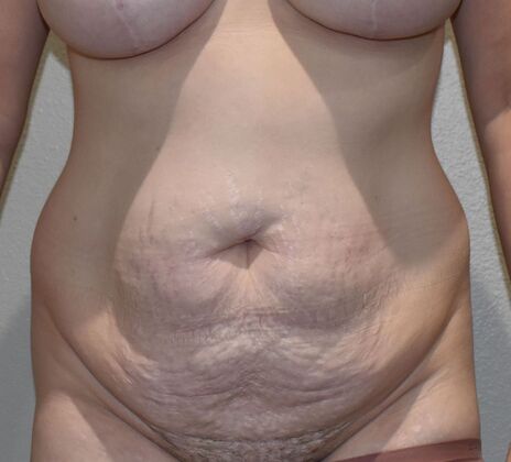 Tummy Tuck (Abdominoplasty): Case 496 - Before