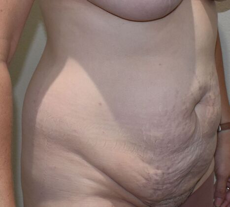 Tummy Tuck (Abdominoplasty): Case 496 - Before