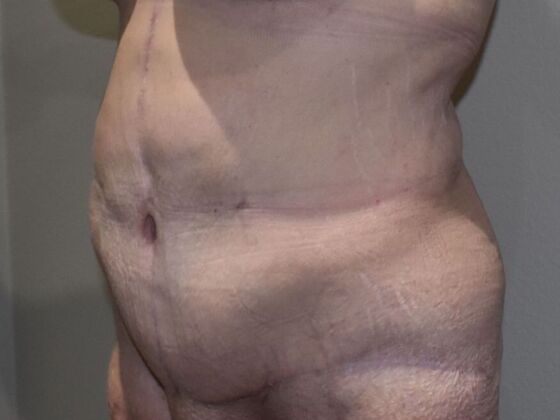 Massive Weight Loss : Case 143 - After