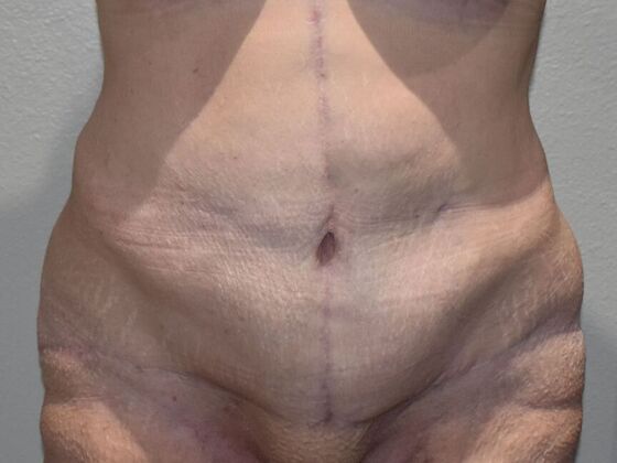 Tummy Tuck (Abdominoplasty): Case 458 - After