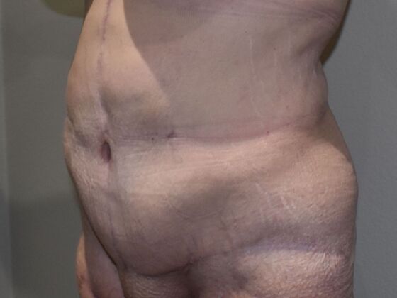 Tummy Tuck (Abdominoplasty): Case 458 - After