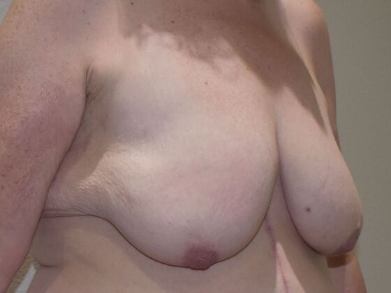 Breast Augmentation w/ Lift: Case 545 - Before