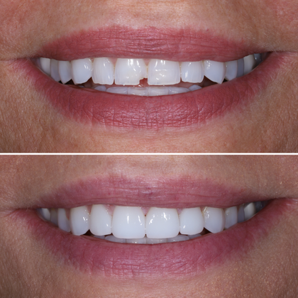 Minimal Prep Porcelain Veneers Barbara - Before