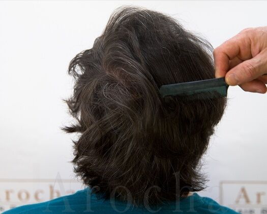 FUE Hair Restoration: Case 39 - After