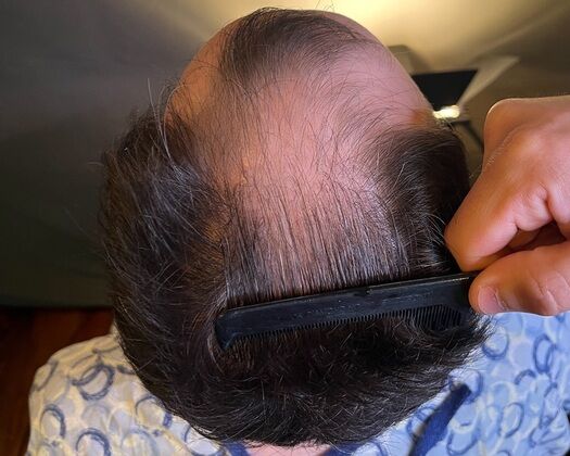 FUE Hair Restoration: Case 39 - Before