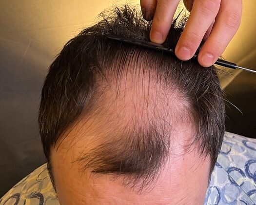 FUE Hair Restoration: Case 39 - Before