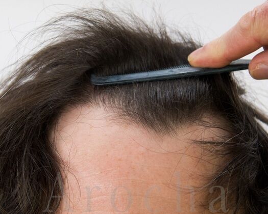 FUE Hair Restoration: Case 39 - After