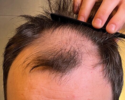 FUE Hair Restoration: Case 39 - Before