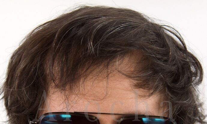 FUE Hair Restoration: Case 39 - After