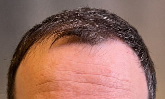 FUE Hair Restoration: Case 39 - Before