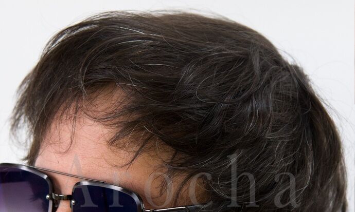 FUE Hair Restoration: Case 39 - After