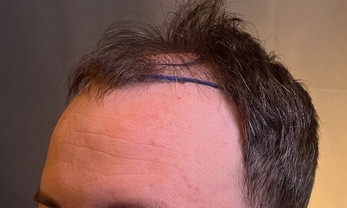 FUE Hair Restoration: Case 39 - Before