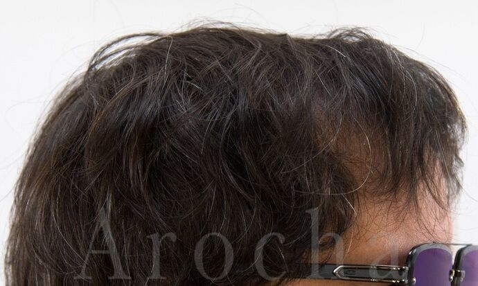 FUE Hair Restoration: Case 39 - After