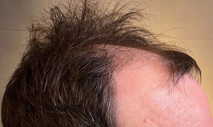 FUE Hair Restoration: Case 39 - Before