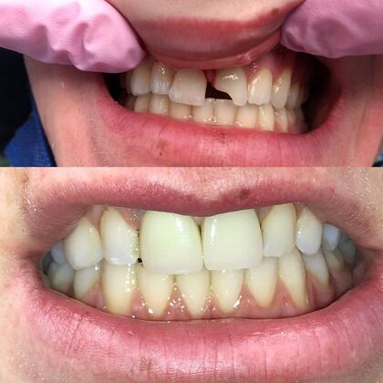 Click Here to See More Before & After Photos: Singular Crown Anterior