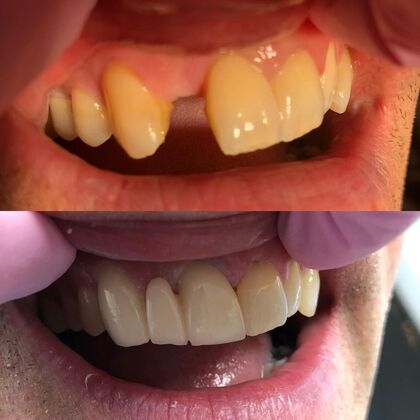 Click Here to See More Before & After Photos Anterior Maxillary Bridge