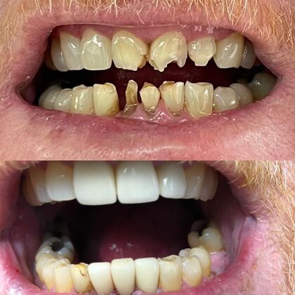 Click Here to See More Before & After Photos Singular Crown 2