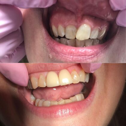 Click Here to See More Before & After Photos Singular Crown 3