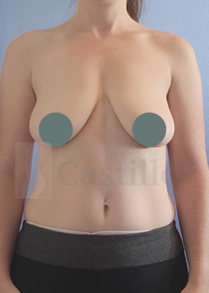 Breast Lift: Breast Lift With Implants - Before