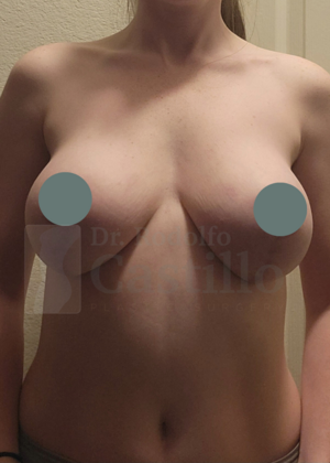 Breast Lift: Breast Lift With Implants - After