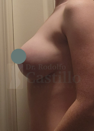 Breast Lift: Breast Lift With Implants - After