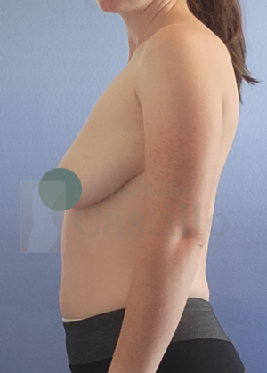 Breast Lift: Breast Lift With Implants - Before