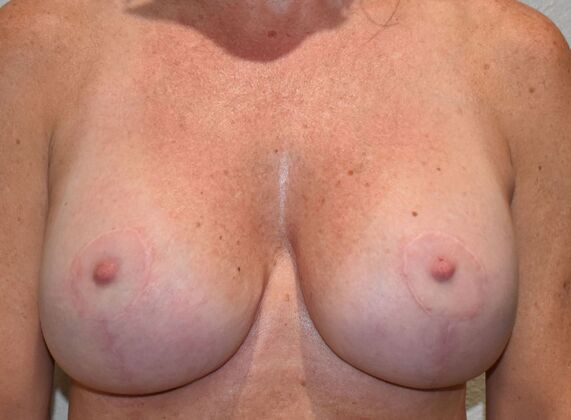 Breast Augmentation w/ Lift Case 541 - After
