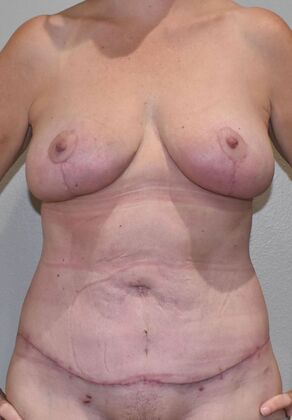 Mommy Makeover Case 317 - After