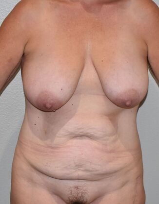 Mommy Makeover Case 317 - Before