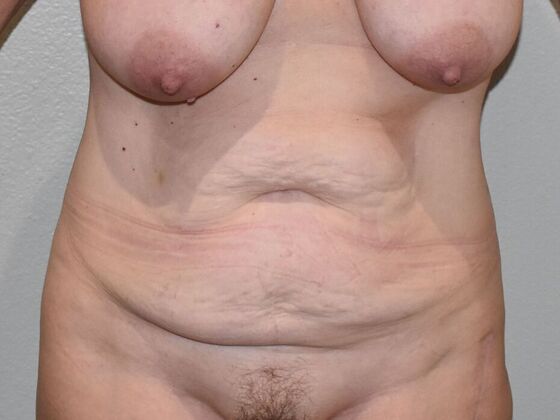 Tummy Tuck (Abdominoplasty): Case 497 - Before