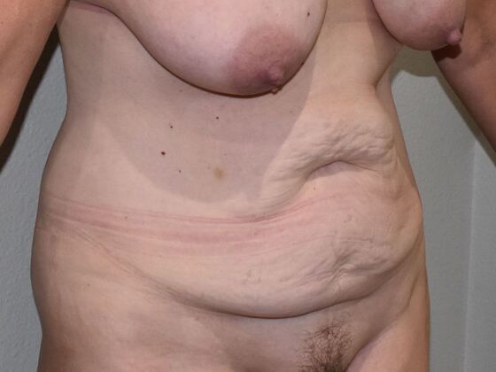 Tummy Tuck (Abdominoplasty): Case 497 - Before