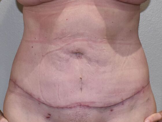 Tummy Tuck (Abdominoplasty): Case 497 - After