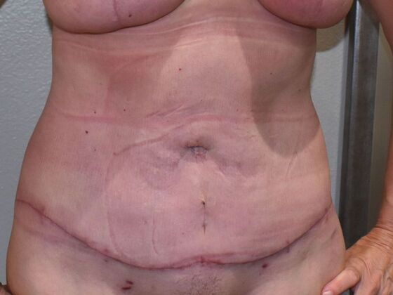 Tummy Tuck (Abdominoplasty): Case 497 - After