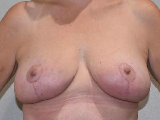 Breast Lift (Mastopexy) Case 217 - After
