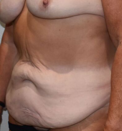 Tummy Tuck (Abdominoplasty): Case 498 - Before