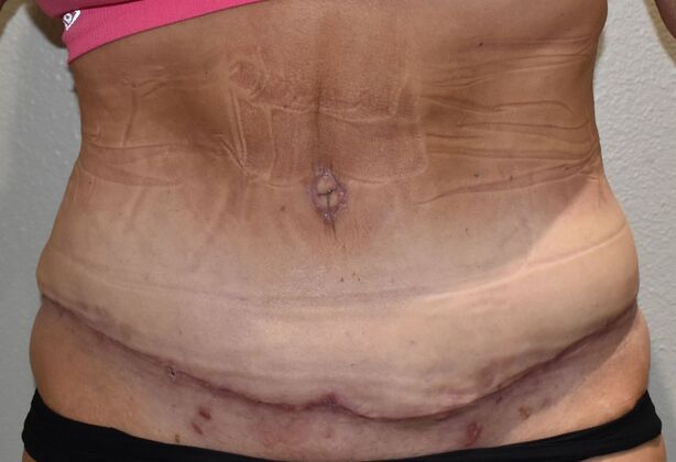Tummy Tuck (Abdominoplasty): Case 498 - After