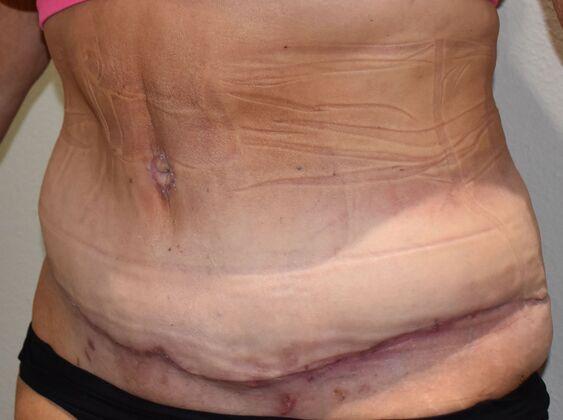 Tummy Tuck (Abdominoplasty): Case 498 - After