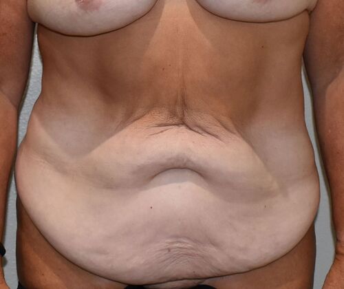 Tummy Tuck (Abdominoplasty): Case 498 - Before