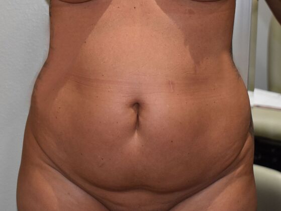 Tummy Tuck (Abdominoplasty): Case 499 - Before