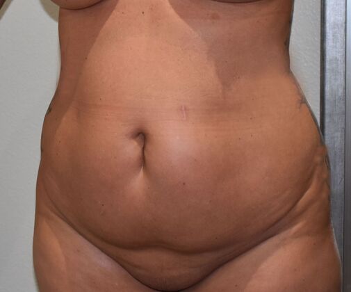 Tummy Tuck (Abdominoplasty): Case 499 - Before