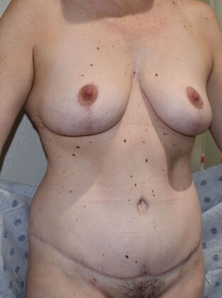 Mommy Makeover: Case 318 - After