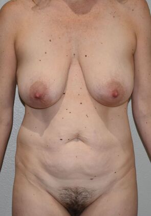 Mommy Makeover Case 318 - Before