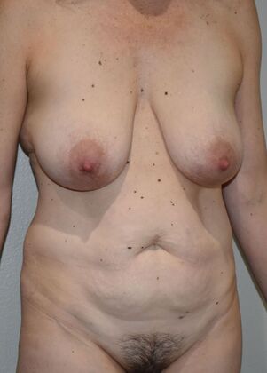 Mommy Makeover: Case 318 - Before