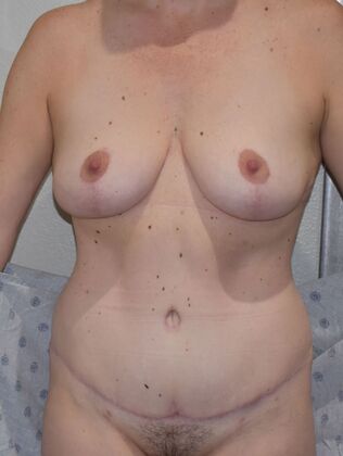 Mommy Makeover Case 318 - After