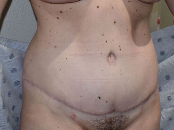 Tummy Tuck (Abdominoplasty): Case 500 - After