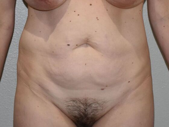 Tummy Tuck (Abdominoplasty): Case 500 - Before