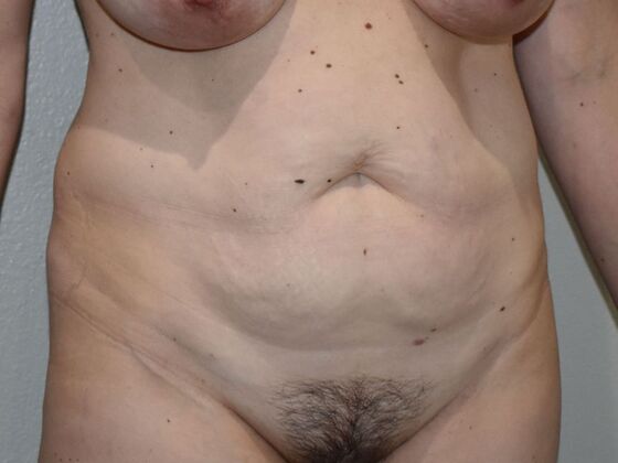 Tummy Tuck (Abdominoplasty): Case 500 - Before